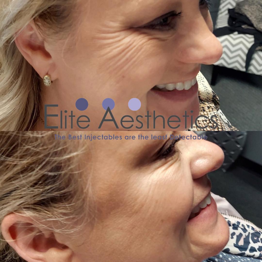 Peels - Chemical peels Overland Park Kansas
