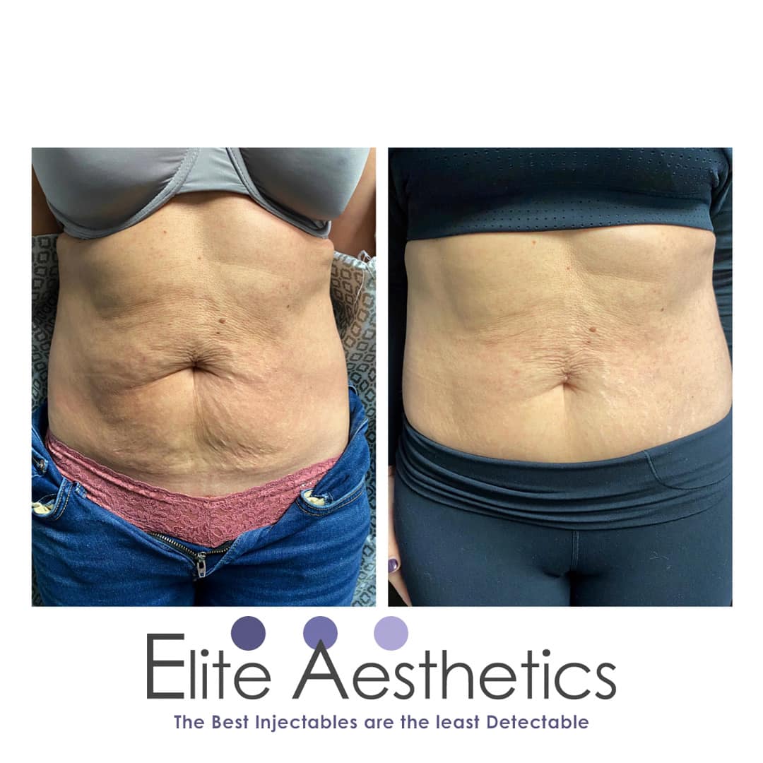 Fat reduction Overland Park Kansas