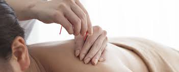 What happens if you hit a nerve during acupuncture?