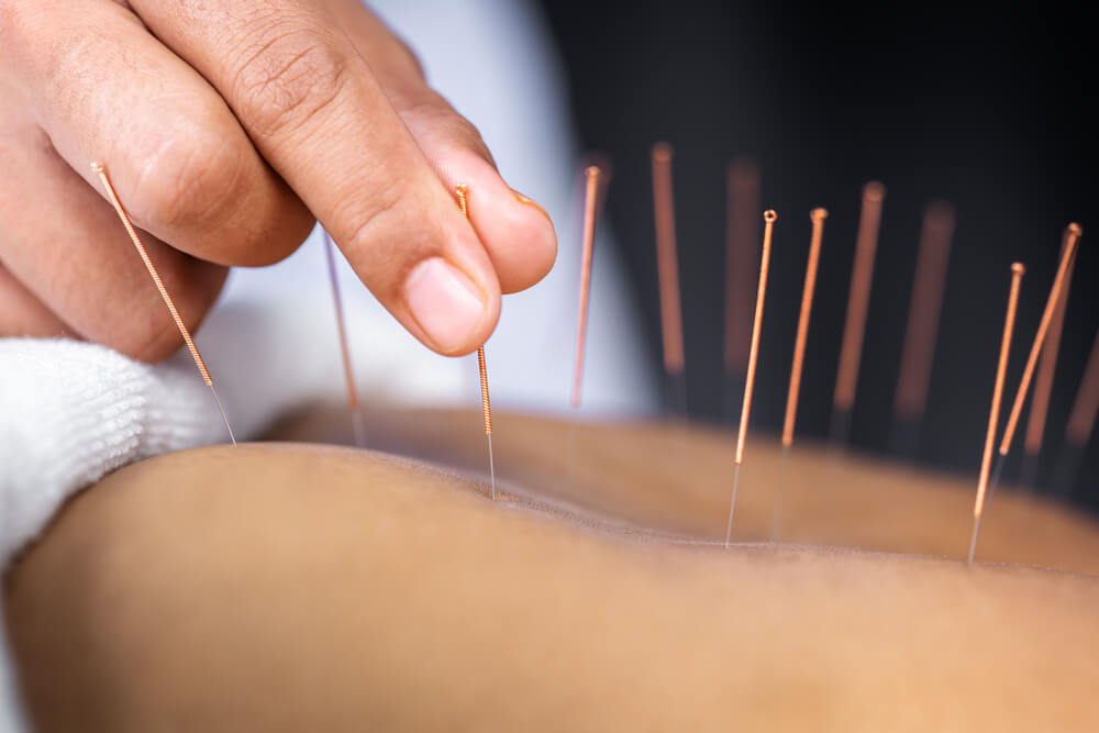 What are the two types of acupuncture?