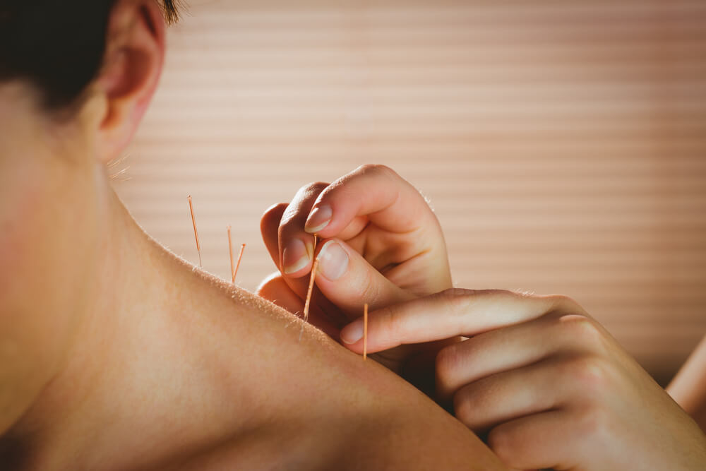 What type of healing is acupuncture?