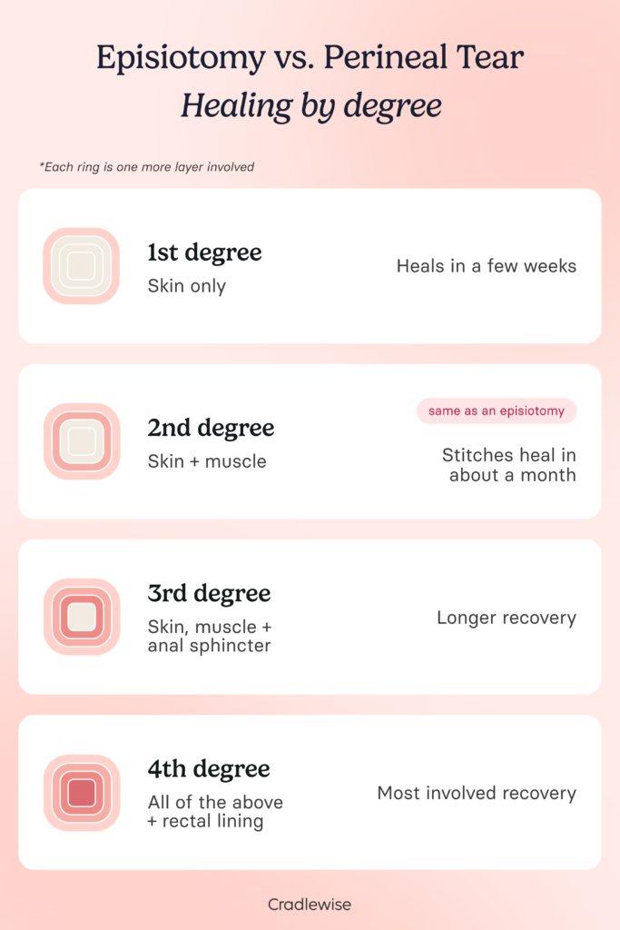 Graphic showing Episiotomy vs Perineal Tear, 4 types of episiotomy and healing by degree