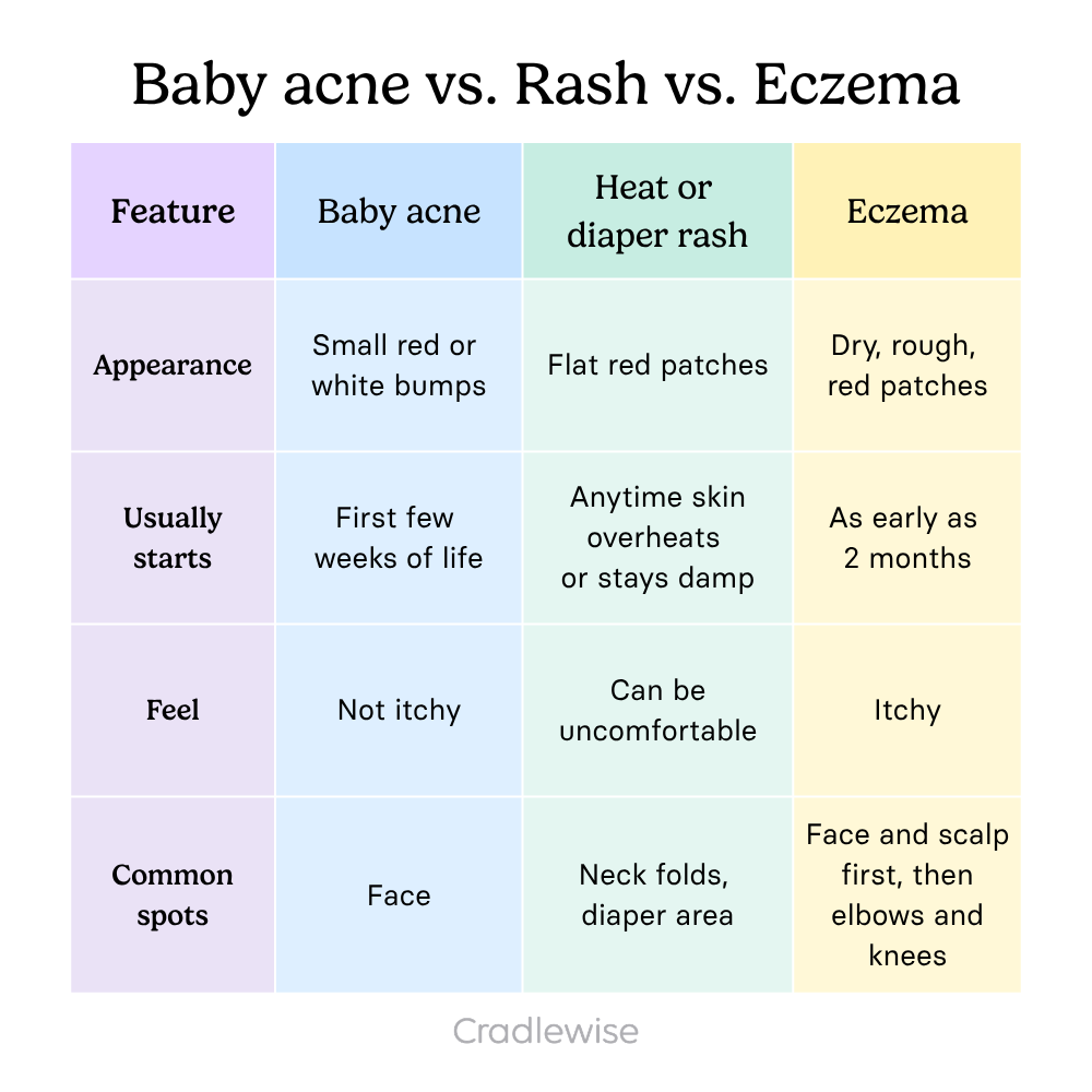 Graphic table showing comparison between baby acne vs baby eczema vs heat or diaper rash