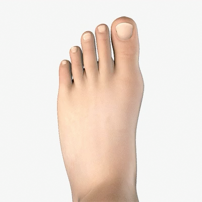 Bunion Animation