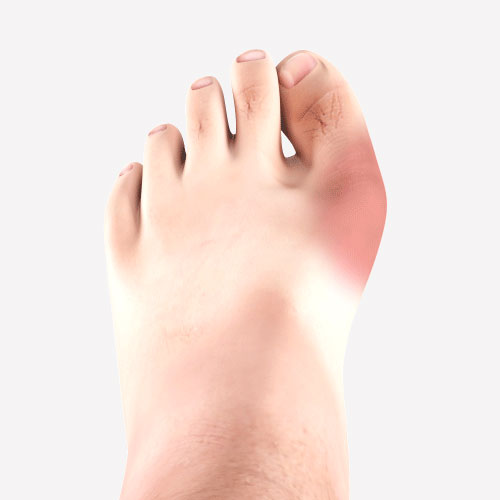 Bunion Animation