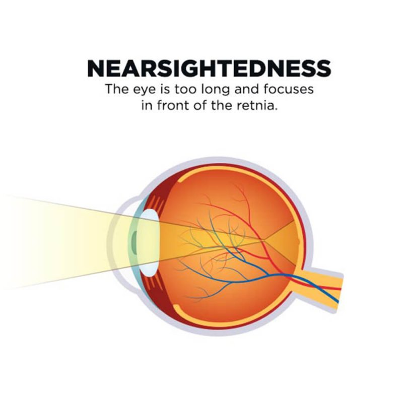 Nearsightedness