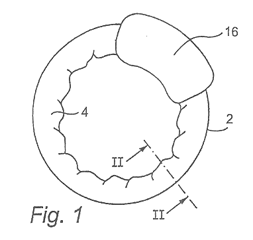 Imagen de la patente DISPOSITIVO DE CONSTRICCION MULTIMATERIAL PARA FORMAR ABERTURAS ESTOMALES.