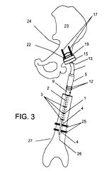 Imagen de la patente ENDOPROTESIS TUMORAL NO CONVENCIONAL ELONGABLE PARA RODILLA, PARA IMPLANTES EN NIÑOS Y ADOLESCENTES.