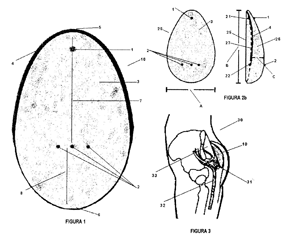 Imagen de la patente IMPLANTE DE GLUTEO UNIVERSAL