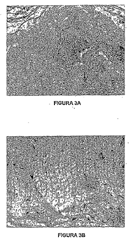 Imagen de la patente USO DE UNA COMPOSICION VISCOELASTICA PARA TRATAMIENTO DE PRESION INTRAOCULAR INCREMENTADA.