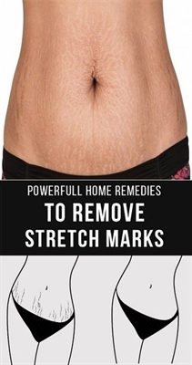 When Do Stretch Marks Come During Pregnancy