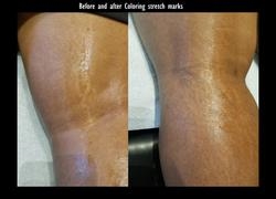 How To Get Rid Of Old Scars And Stretch Marks