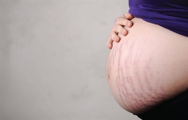 Tips For Removing Pregnancy Stretch Marks