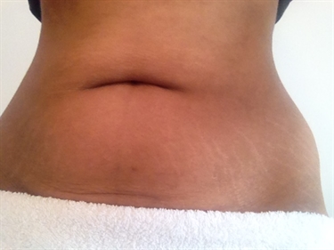 Cheap Stretch Mark Creams