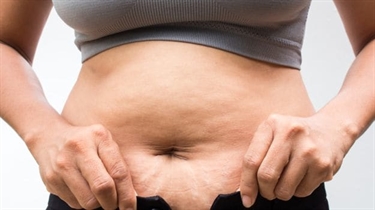 What Helps Prevent Stretch Marks