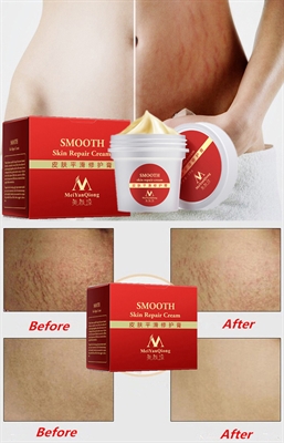 How To Cover Up Stretch Marks On Legs