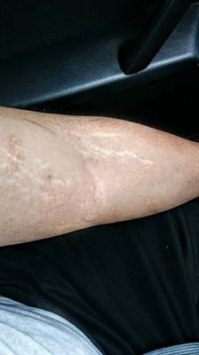 Do C Section Scars Fade