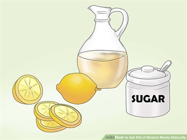 How Much Is It To Get Stretch Marks Removed