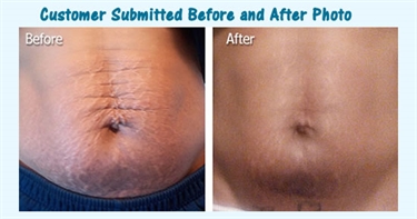 When To Start Using Stretch Mark Cream During Pregnancy