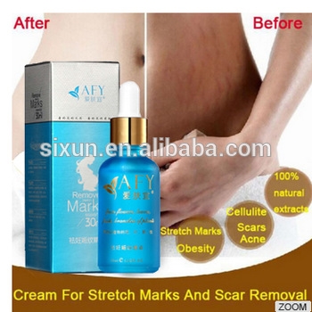 Pregnancy Prediction By Stretch Marks