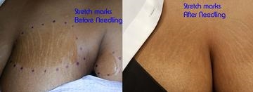 What Do Stretch Marks Look Like