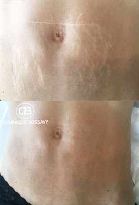 How To Cover Stretch Marks