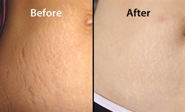 How To Prevent Pregnancy Stretch Marks