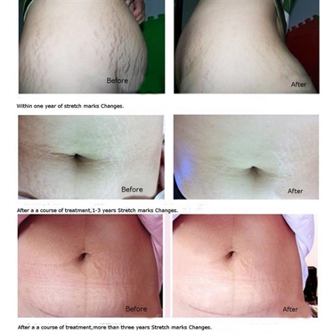 How Much Can Your Stomach Stretch