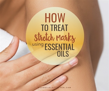How Can I Avoid Stretch Marks In Pregnancy