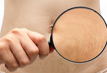 How To Lighten Your Buttocks Naturally