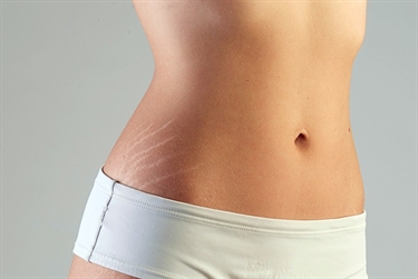 Stretch Marks Removal After Pregnancy Home Remedies