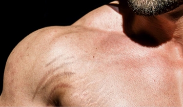 How To Improve Stretch Marks