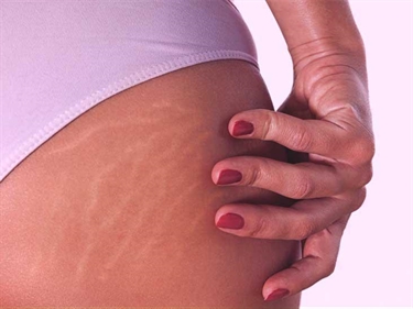 How Do You Know If You Have Stretch Marks