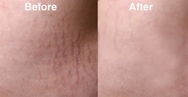 Celebrities Stretch Marks