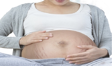 Does Itchy Skin During Pregnancy Mean Stretch Marks