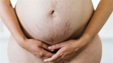 How To Prevent Stretch Marks With Pregnancy