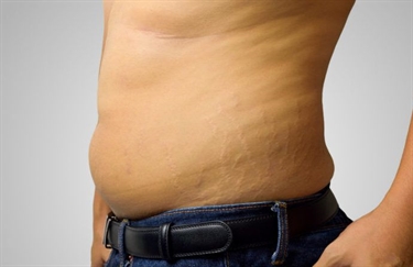 How To Remove Old Stretch Marks