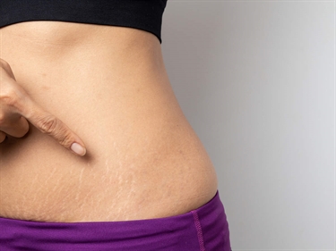 When Do Stretch Marks Form In Pregnancy