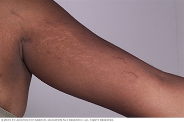 Hide Stretch Marks