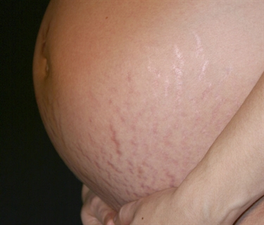How To Cover Up Stretch Marks On Arms