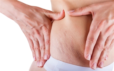Stretch Mark Creams For Pregnancy