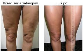 How To Remove Scars On Legs In One Week
