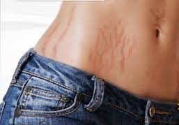 Do Stretch Marks Go Away With Exercise