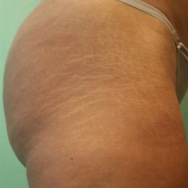 How Do People Get Stretch Marks