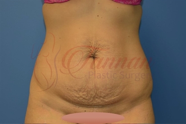 How Remove Stretch Marks