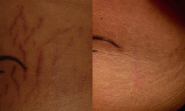 Post Pregnancy Stretch Marks Tumblr