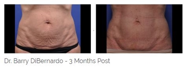 How Do You Lose Stretch Marks