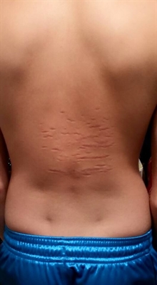 Why Is There A Dark Line On My Stomach