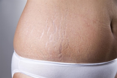 How To Fade Scars Fast