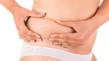 How To Remove Stretch Marks Fast